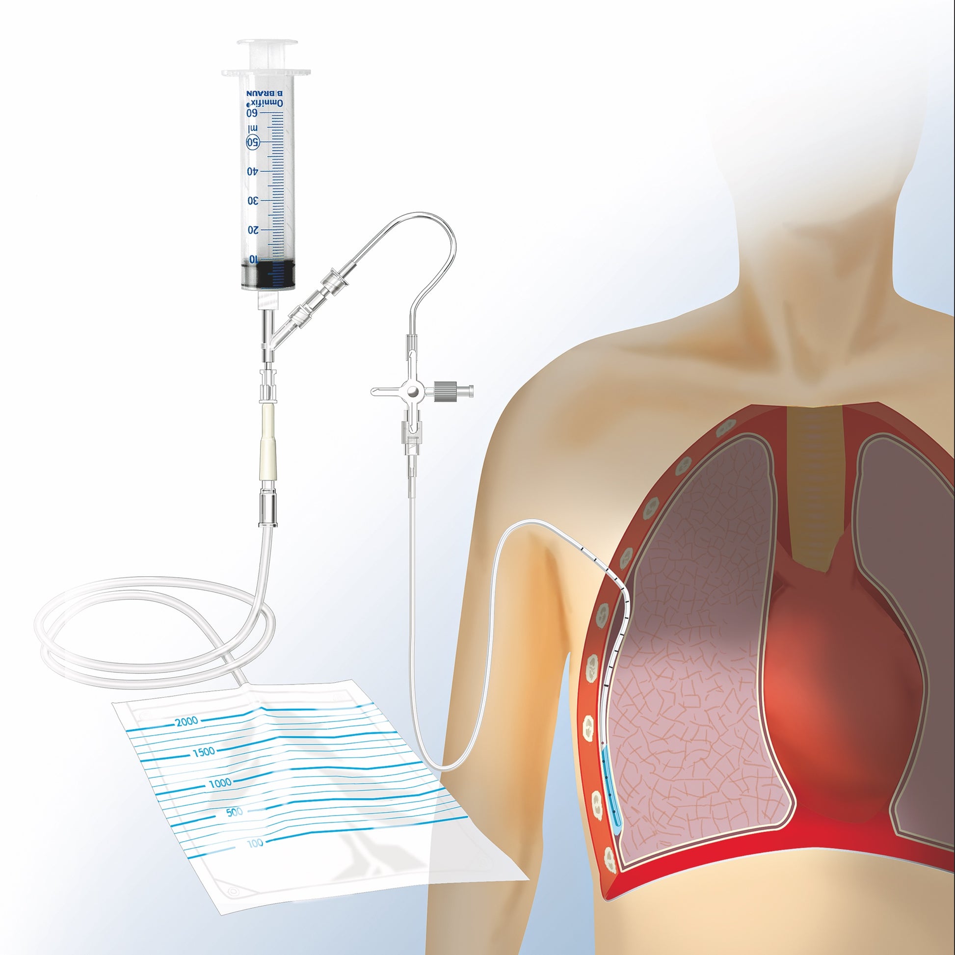 Pleural and Thoracic Drainage Set—Complete Set According to Matthys